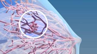 Breast Cancer  3D Medical Animation  ABP © [upl. by Ileyan454]