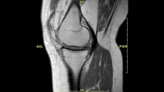 Meniscal root tear  complete MRI examination [upl. by Yursa]