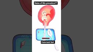 Comment the procedure procedure medical medicalprocedurevideos medicalprocedure medicalstudent [upl. by Larrad438]