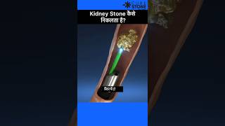 Kidney Stone treatment  laser treatment of ureteric stone  Shorts  RIRS [upl. by Pilloff]