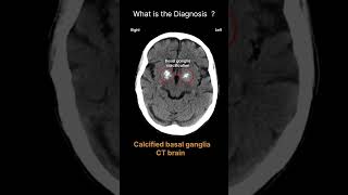 Calcified basal ganglia  CT brain CT Brain Anatomy Calcified Quiz 37 radiologychannel007 [upl. by Conover]