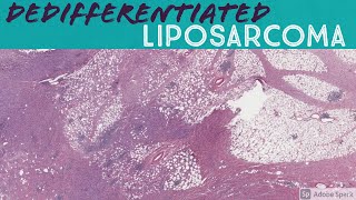 Dedifferentiated liposarcoma with heterologous osteosarcoma component [upl. by Seema]