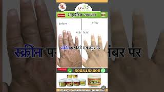 Eczema ayurvedic skin care [upl. by Byrann]