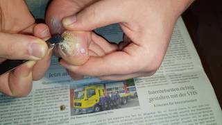 Plantar Wart removing part 3 23  Dornwarzen etnfernen Teil 3 23 [upl. by Soulier996]