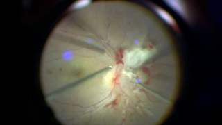 Performing 27gauge diabetic vitrectomy [upl. by Elletnuahc]