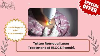 Tattoo Removal laser treatment at Hlccs RanchiCall now 93343349335 tattooremoval tattoo [upl. by Rendrag]