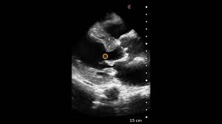 Concentric Left Ventricular Hypertrophy LVH  Ultrasound Image Interpretation [upl. by Eisnil]