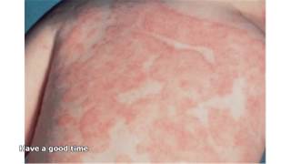 fungal skin infections pictures [upl. by Leboff]