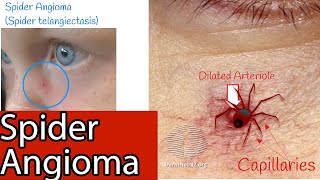 Spider Angioma  Capillaries on the face Spider spider telangiectasia Causes and Treatment [upl. by Jacobine]