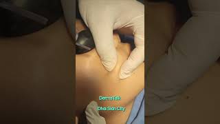 Mole Removal with Blade and Co2 Laser [upl. by Emia542]