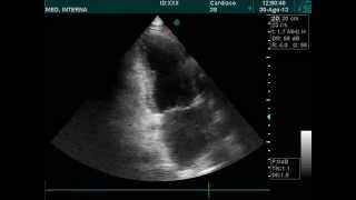 Apical hypokinesis echocardiography doppler ultrasound [upl. by Zoila]