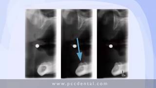 Ask Gordon How much bone for mini implants [upl. by Iat]