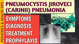 Pneumocystis Jiroveci Pneumonia P Carinii Symptoms Radiology Treatment amp Prophylaxis [upl. by Moyra]