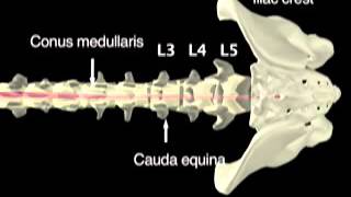 NEJM  Lumbar Puncture [upl. by Junie]