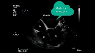 What´s the reason for the stroke Lets shed some light with echocardiography [upl. by Sulamith]