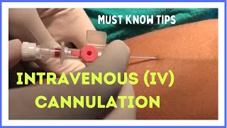 INTRAVENOUS IV CANNULATION in 5 mins How to insert [upl. by Aicile589]