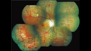 Diabetic Retinopathy Laser Surgery [upl. by Haeckel]