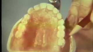 Preparation of Immediate Denture for Delivery [upl. by Burnham]