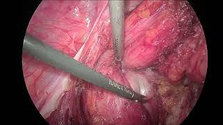 Laparoscopic Excision of a sacrococcygeal teratoma [upl. by Elleniad32]