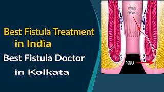 Best Fistula Treatment in India  Best Fistula Doctor in Kolkata [upl. by Lotti163]