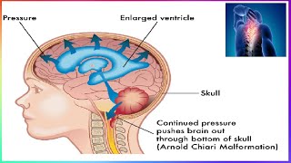 👀Syringomyelia🩺You may not have symptoms or even be aware that you have it🔴 [upl. by Renaud166]