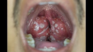 Tonsil Stones Remedy Forever Pdf  Get Rid Of Tonsil Stones amp Morning Breath [upl. by Ellesirg302]