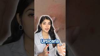 How I Cured My Urticaria Chronic Hives  My Story [upl. by Travers]