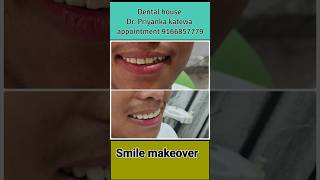 smile design treatment jaipur smiledental cosmeticdentistry [upl. by Rosana]