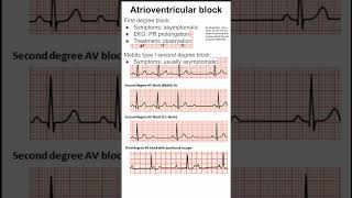 Atrioventricular block [upl. by Dranoel]