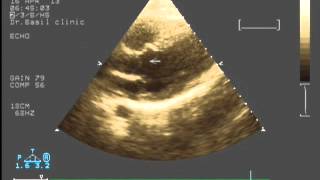 subvalvular aortic stenosis [upl. by Brandon]