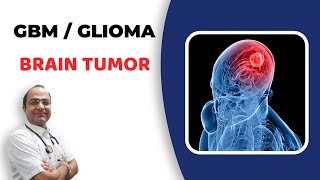 Glioma Brain Tumour Treatment  GlioblastomaGBM Cancer  दिमाग का कैंसर  Best Homeopathic Doctor [upl. by Lellih879]