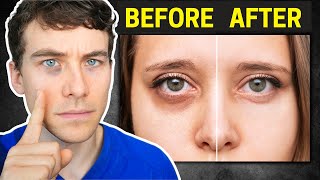 The Truth about Dark Circles Causes and Proven Treatments [upl. by Noach]