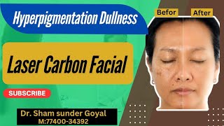 Hyperpigmentation  Dullness  Facial Rejuvenation  Laser Carbon Facial  Kayakalp Laser Clinic [upl. by Morly]