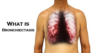 What is Bronchiectasis  Dr Technology [upl. by Anwahsed]