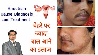 Hirsutism Cause Diagnosis amp Treatment चेहरे पर ज्यादा बाल आने का इलाज़ hirsutism pcod diodelaser [upl. by Laenej]