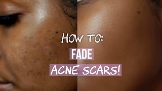 HOW TO GET RID OF ACNE SCARS ON FACE amp BODY [upl. by Yuh840]