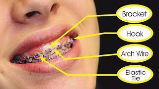 PARTS OF BRACES How They Work [upl. by Niawtna]