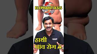 Elephantiasis Filariasis  हाथी पांव रोग 😰 disease neetpreparation neetexam [upl. by Navonoj]