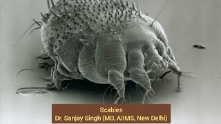 Scabies  Disease  Diagnosis  Treatment by Dr Sanjay Singh MD AIIMS New Delhi scabies itch [upl. by Heise]