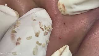 Big Cystic Acne Blackheads Extraction Blackheads amp Milia Whiteheads Removal Pimple Popping [upl. by Ellehsem]