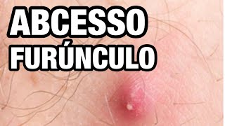 FURÚNCULO COMO TRATAR ABSCESSO TUMOR DE PUS [upl. by Ahsiekal]