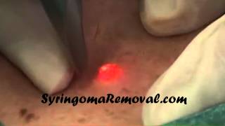 Syringoma removal using cosmetic lasers [upl. by Hinson]