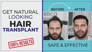 Hair Transplant Delhi  Best Hair Transplant Results  Cosmetica India clinic  Dr Chandra Prakash [upl. by Liagiba]