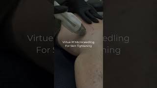 Virtue RF Microneedling For Skin Tightening [upl. by Ttehc]