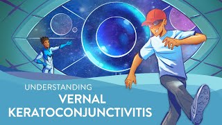 Understanding Vernal Keratoconjunctivitis VKC [upl. by Constantino]