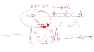 Bloqueos auriculoventriculares [upl. by Ylrad]
