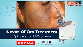 Nevus Of Ota Treatment by Q Switch Nd YAG Laser Helios  Nevus of OTA  Birth Mark  Laser Treatment [upl. by Juanne317]