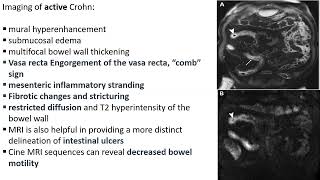 Diffusely Infiltrative Small Bowel Disease dr Sara Tawfiq [upl. by Prent115]