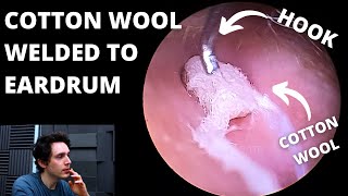 Cotton Wool Welded To Eardrums Why Dont We Numb Up Patients [upl. by Lillian]