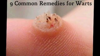 9 Common Remedies for Warts [upl. by Nyledaj479]